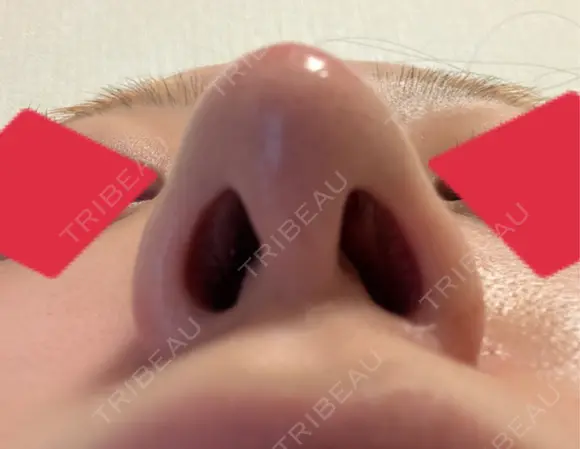 鼻尖形成（切開） / 小鼻縮小（切開） / 軟骨移植 / 鼻尖縮小 東京シンデレラ美容外科 新宿院 AFTER メイン用