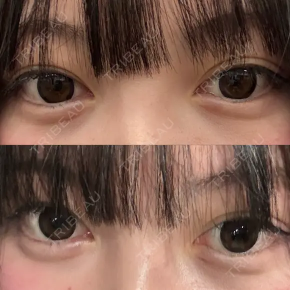ヒアルロン酸注入（涙袋） / ヒアルロン酸注入（唇） HAAB BEAUTY CLINIC 南青山本院（新院） DAY 0 メイン用
