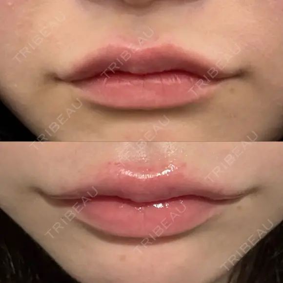 ヒアルロン酸注入（涙袋） / ヒアルロン酸注入（唇） HAAB BEAUTY CLINIC 南青山本院（新院） DAY 0 メイン用