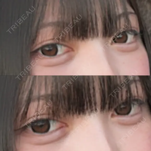 ヒアルロン酸注入（涙袋） / ヒアルロン酸注入（唇） HAAB BEAUTY CLINIC 南青山本院（新院） AFTER メイン用