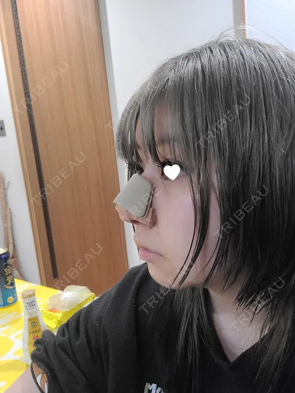 鼻尖形成（切開） / 鼻中隔延長（切開） / 小鼻縮小（切開） / 軟骨移植 / 骨切幅寄せ / 鼻柱下降・鼻唇角形成（猫手術） WOM CLINIC GINZA （ワム クリニック ギンザ） DAY 12 メイン用