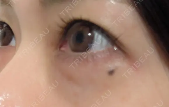 ヒアルロン酸注入（涙袋） / ヒアルロン酸注入（鼻） / 肌ヒアルロン酸注入（たるみ・シワ改善） / ヒアルロン酸注入（あご） / 豊胸（ヒアルロン酸） / ヒアルロン酸注入（唇） / ヒアルロン酸溶解 / ヒアルロン酸注入（額） / ヒアルロン酸注入（頬） / ヒアルロン酸注入（目の下） / ヒアルロン酸注入（こめかみ） / ヒアルロン酸注入（首） / ヒアルロン酸注入（耳たぶ） / ヒアルロン酸注入（鼻翼基部） MKクリニック 日本橋院 DAY 8 メイン用