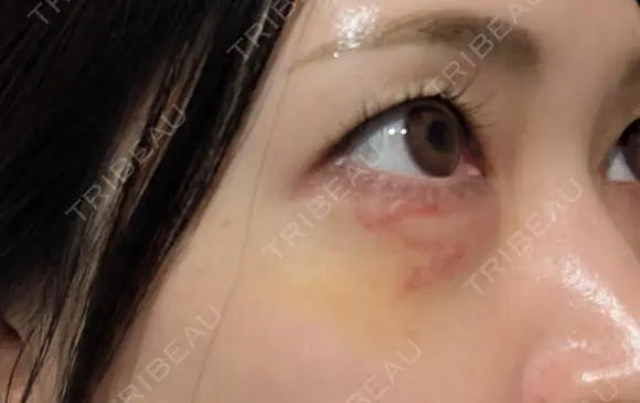 ヒアルロン酸注入（涙袋） / ヒアルロン酸注入（鼻） / 肌ヒアルロン酸注入（たるみ・シワ改善） / ヒアルロン酸注入（あご） / 豊胸（ヒアルロン酸） / ヒアルロン酸注入（唇） / ヒアルロン酸溶解 / ヒアルロン酸注入（額） / ヒアルロン酸注入（頬） / ヒアルロン酸注入（目の下） / ヒアルロン酸注入（こめかみ） / ヒアルロン酸注入（首） / ヒアルロン酸注入（耳たぶ） / ヒアルロン酸注入（鼻翼基部） MKクリニック 日本橋院 DAY 8 メイン用