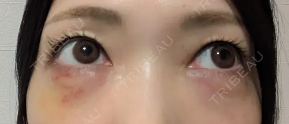 ヒアルロン酸注入（涙袋） / ヒアルロン酸注入（鼻） / 肌ヒアルロン酸注入（たるみ・シワ改善） / ヒアルロン酸注入（あご） / 豊胸（ヒアルロン酸） / ヒアルロン酸注入（唇） / ヒアルロン酸溶解 / ヒアルロン酸注入（額） / ヒアルロン酸注入（頬） / ヒアルロン酸注入（目の下） / ヒアルロン酸注入（こめかみ） / ヒアルロン酸注入（首） / ヒアルロン酸注入（耳たぶ） / ヒアルロン酸注入（鼻翼基部） MKクリニック 日本橋院 DAY 8 メイン用