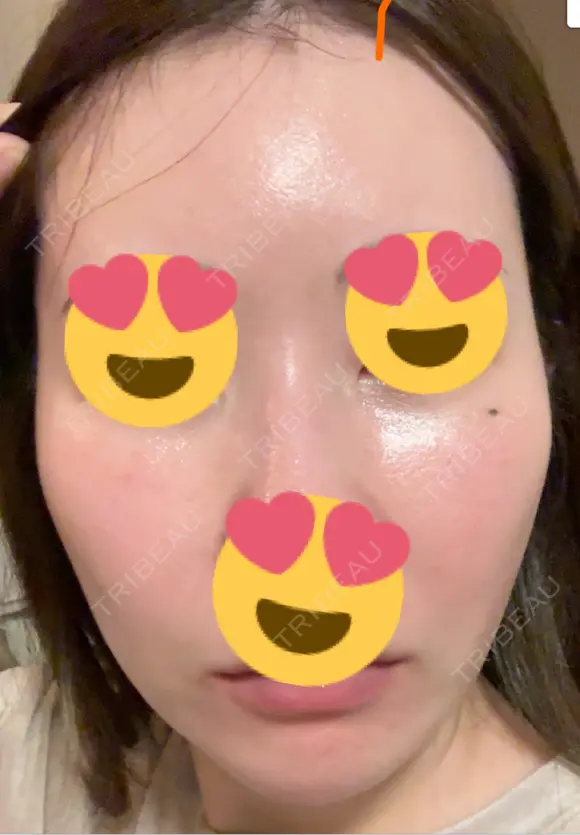 フラクショナルレーザー（毛穴・ニキビ跡） おおかみ美容のクリニック 新宿院 DAY 9 メイン用