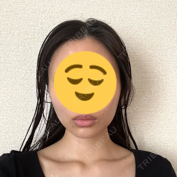 糸リフト / 脂肪吸引（顔） EMMA CLINIC（エマクリニック） DAY 32 メイン用