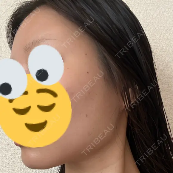 糸リフト / 脂肪吸引（顔） EMMA CLINIC（エマクリニック） DAY 32 メイン用