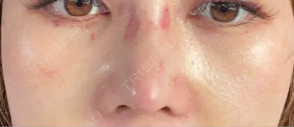 隆鼻術 / 鼻尖形成（切開） / 鼻中隔延長（切開） / 下まぶたたるみ取り / 下まぶたの脂肪取り / 軟骨移植 R Beauty CLINIC 銀座院 AFTER メイン用