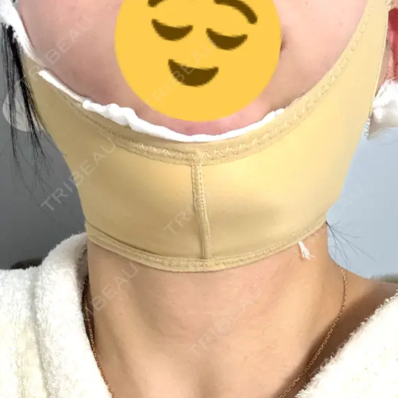 糸リフト / 脂肪吸引（顔） / ボトックス（エラ・小顔） Wing clinic 豊中駅前院 DAY 0 メイン用