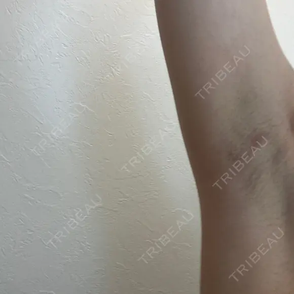 医療脱毛（ワキ） ルラ美容クリニック 新宿院 AFTER メイン用