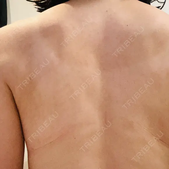 ピコフラクショナルレーザー（毛穴・ニキビ跡） ルラ美容クリニック 広島院 DAY 10 メイン用