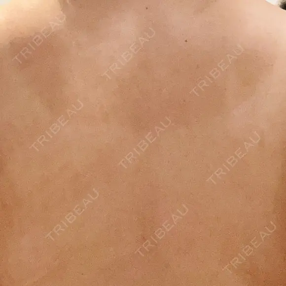 ピコフラクショナルレーザー（毛穴・ニキビ跡） ルラ美容クリニック 広島院 DAY 11 メイン用