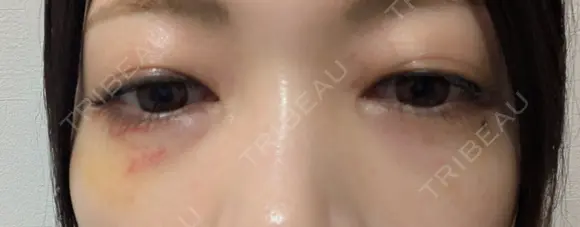 ヒアルロン酸注入（涙袋） / ヒアルロン酸注入（鼻） / 肌ヒアルロン酸注入（たるみ・シワ改善） / ヒアルロン酸注入（あご） / 豊胸（ヒアルロン酸） / ヒアルロン酸注入（唇） / ヒアルロン酸溶解 / ヒアルロン酸注入（額） / ヒアルロン酸注入（頬） / ヒアルロン酸注入（目の下） / ヒアルロン酸注入（こめかみ） / ヒアルロン酸注入（首） / ヒアルロン酸注入（耳たぶ） / ヒアルロン酸注入（鼻翼基部） MKクリニック 日本橋院 DAY 9 メイン用