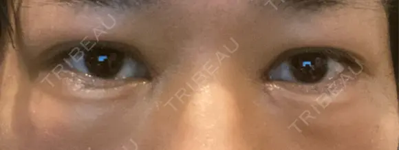 二重埋没 / 目頭切開 eクリニック 横浜みなとみらい院 AFTER メイン用