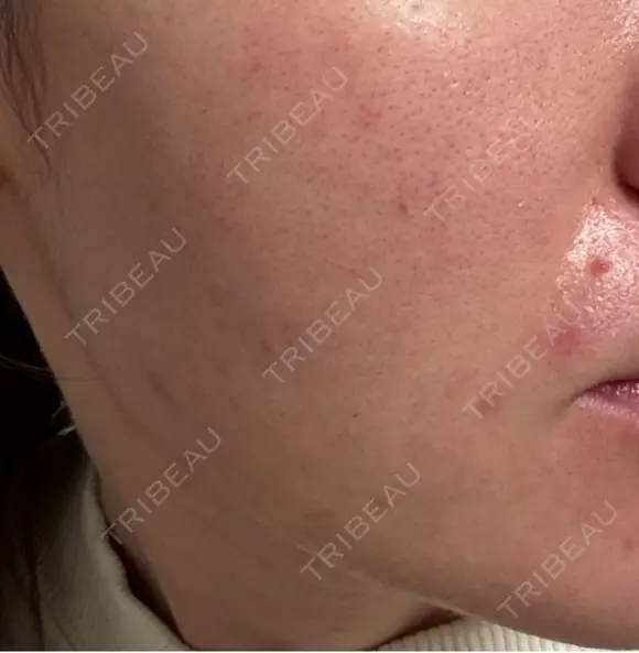 エレクトロポレーション / 毛穴洗浄（ハイドラフェイシャルなど） / ニードルRF（ポテンツァなど） クレオビューティークリニック AFTER メイン用