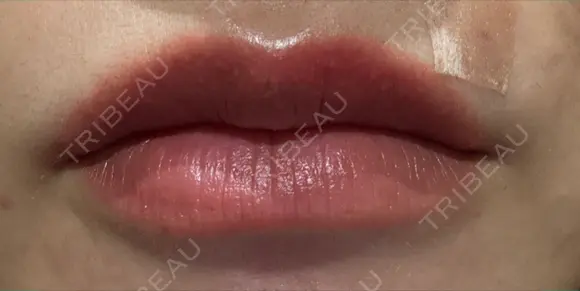 アートメイク（唇） セカジソウォン医院-明洞店 DAY 4 メイン用