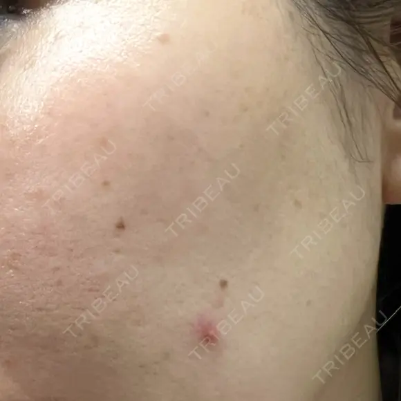 ルメッカ J CLINIC DAY 8 メイン用