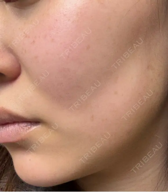 ボトックス（エラ・小顔） / ボトックス（眉間） / ボトックス（額） / ボトックス（バニーライン） Natural Skin Clinic 自由ヶ丘院 AFTER メイン用