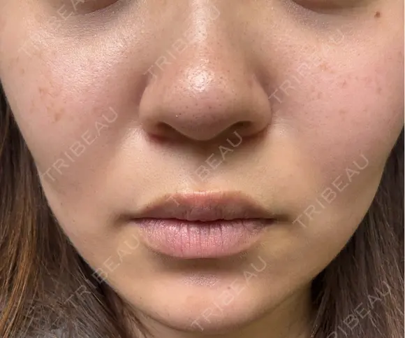 ボトックス（エラ・小顔） / ボトックス（眉間） / ボトックス（額） / ボトックス（バニーライン） Natural Skin Clinic 自由ヶ丘院 DAY 0 メイン用