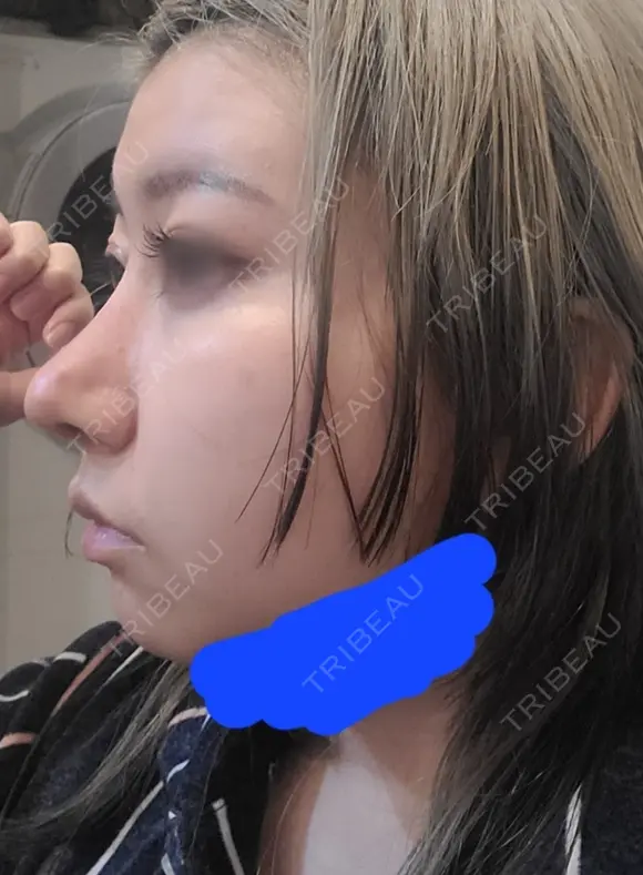 鼻尖形成（切開） / 鼻中隔延長（切開） / 小鼻縮小（切開） / 軟骨移植 / 骨切幅寄せ / 鼻柱下降・鼻唇角形成（猫手術） WOM CLINIC GINZA （ワム クリニック ギンザ） DAY 14 メイン用