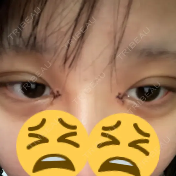 目頭切開 池袋麗歯科・美容皮膚科 AFTER メイン用