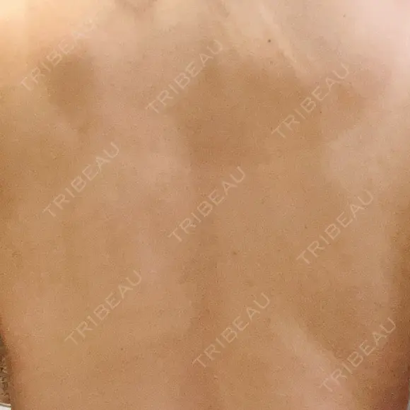 ピコフラクショナルレーザー（毛穴・ニキビ跡） ルラ美容クリニック 広島院 DAY 12 メイン用