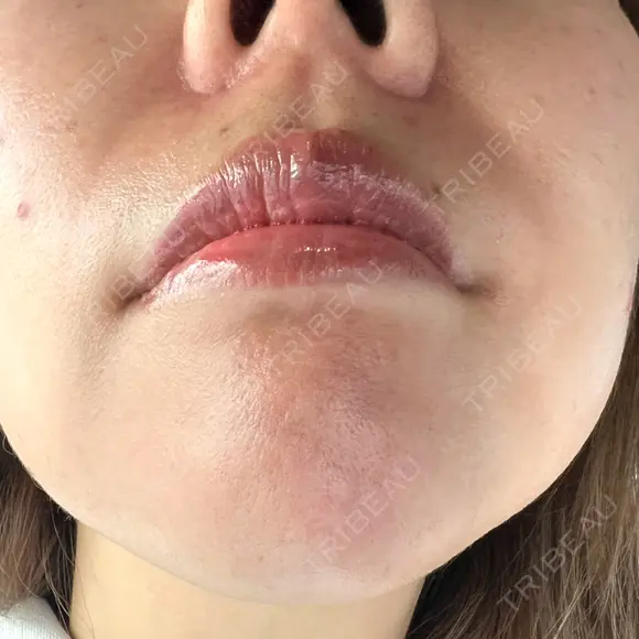ルメッカ J CLINIC DAY 9 メイン用