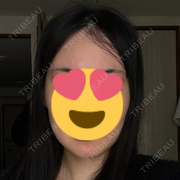 脂肪吸引（顔） / ネックリフト リラ・クラニオフェイシャル・クリニック DAY 32 メイン用