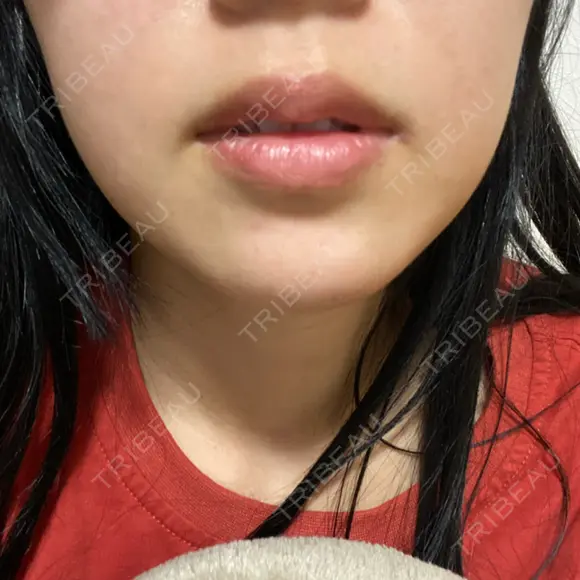 ハイフ（顔） 共立美容外科 大阪本院 AFTER メイン用