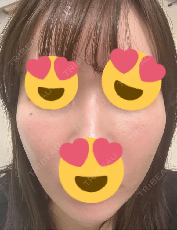 フラクショナルレーザー（毛穴・ニキビ跡） おおかみ美容のクリニック 新宿院 DAY 10 メイン用