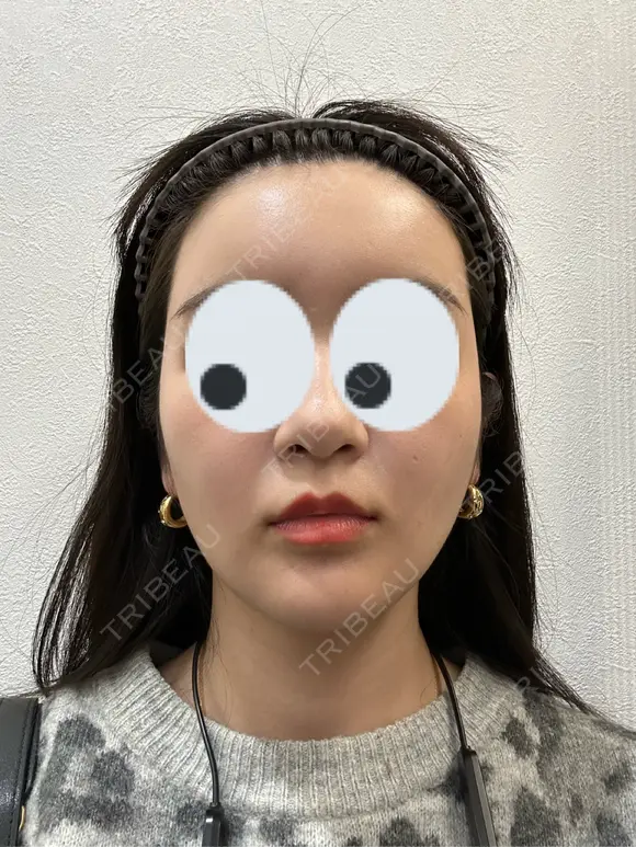 糸リフト / バッカルファット除去 / 脂肪吸引（顔） / 額を丸く / 脂肪吸引（脚） / 脂肪注入（額） / メーラーファット除去 / 脂肪注入（輪郭） First Clinic AFTER メイン用