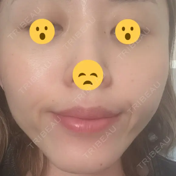 ボトックス（あご） / ボトックス（口角） / ボトックス（眉間） / ボトックス（額） / ボトックス（バニーライン） / その他（鼻） TCB東京中央美容外科 札幌駅前院 DAY 7 メイン用