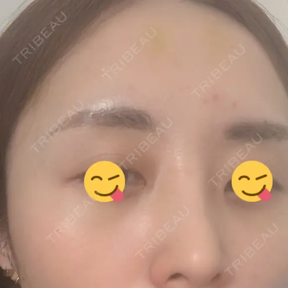 ボトックス（あご） / ボトックス（口角） / ボトックス（眉間） / ボトックス（額） / ボトックス（バニーライン） / その他（鼻） TCB東京中央美容外科 札幌駅前院 DAY 7 メイン用