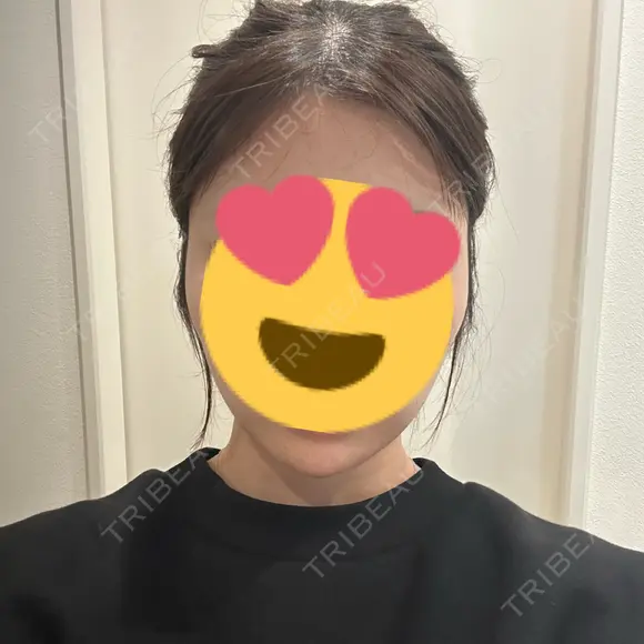ヒアルロン酸注入（あご） HAAB BEAUTY CLINIC 名古屋院 DAY 0 メイン用