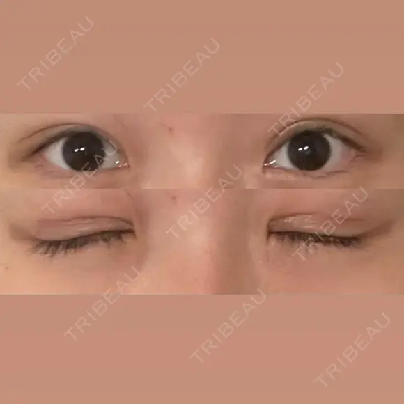 二重切開 / 眼瞼下垂（切開） / 上まぶたたるみ取り eクリニック 福岡院 DAY 18 メイン用