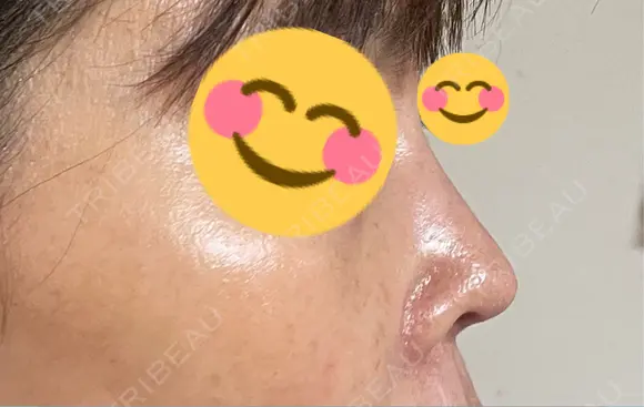 隆鼻術 / 鼻尖形成（切開） / 鼻中隔延長（切開） / 軟骨移植 / プロテーゼ除去 / 鼻修正 東京美容外科 名古屋院 DAY 58 メイン用
