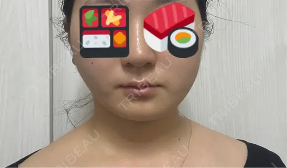 糸リフト / 脂肪吸引（顔） / ジョールファット除去 Wing clinic 豊中駅前院 DAY 12 メイン用