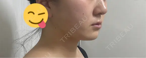 糸リフト / 脂肪吸引（顔） / ジョールファット除去 Wing clinic 豊中駅前院 DAY 12 メイン用