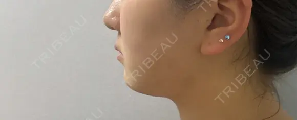 糸リフト / 脂肪吸引（顔） / ジョールファット除去 Wing clinic 豊中駅前院 DAY 12 メイン用