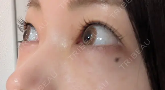 ヒアルロン酸注入（涙袋） / ヒアルロン酸注入（鼻） / 肌ヒアルロン酸注入（たるみ・シワ改善） / ヒアルロン酸注入（あご） / 豊胸（ヒアルロン酸） / ヒアルロン酸注入（唇） / ヒアルロン酸溶解 / ヒアルロン酸注入（額） / ヒアルロン酸注入（頬） / ヒアルロン酸注入（目の下） / ヒアルロン酸注入（こめかみ） / ヒアルロン酸注入（首） / ヒアルロン酸注入（耳たぶ） / ヒアルロン酸注入（鼻翼基部） MKクリニック 日本橋院 DAY 10 メイン用