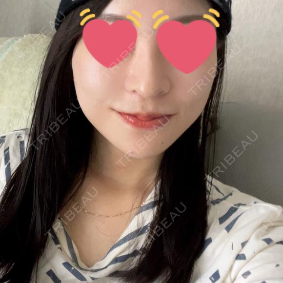 糸リフト / 脂肪吸引（顔） / 脂肪吸引注射（顔） ルラ美容クリニック 岡山院 DAY 97 メイン用