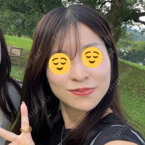 糸リフト / 脂肪吸引（顔） / 脂肪吸引注射（顔） ルラ美容クリニック 岡山院 DAY 44 メイン用