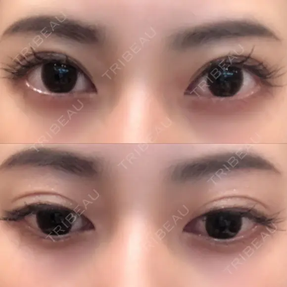 二重切開 ルネッサンス美容外科医院 神戸院 DAY 106 メイン用