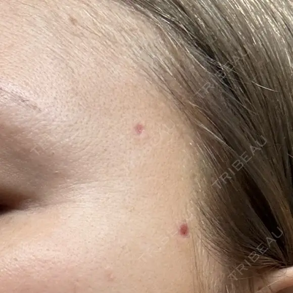 ほくろ・いぼ除去レーザー（肌） Fellez Clinic【フェルズクリニック】 DAY 7 メイン用