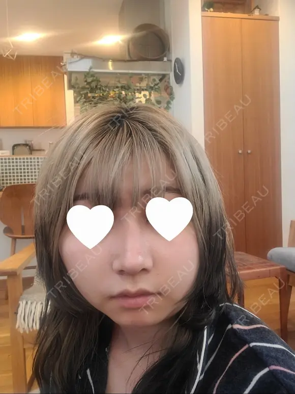 鼻尖形成（切開） / 鼻中隔延長（切開） / 小鼻縮小（切開） / 軟骨移植 / 骨切幅寄せ / 鼻柱下降・鼻唇角形成（猫手術） WOM CLINIC GINZA （ワム クリニック ギンザ） DAY 17 メイン用