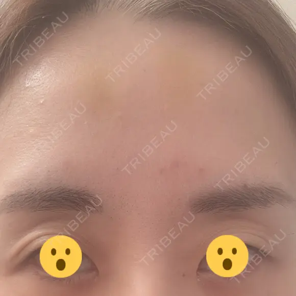 ボトックス（あご） / ボトックス（口角） / ボトックス（眉間） / ボトックス（額） / ボトックス（バニーライン） / その他（鼻） TCB東京中央美容外科 札幌駅前院 DAY 9 メイン用