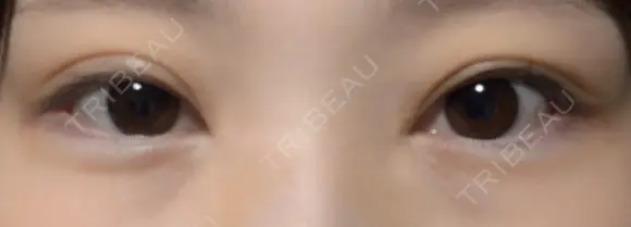 二重切開 / 目頭切開 / 眼瞼下垂（切開） EMMA CLINIC（エマクリニック） AFTER メイン用