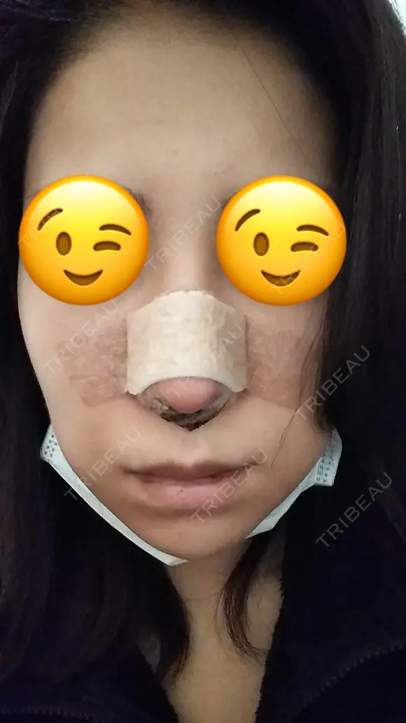 鼻尖形成（切開） / 軟骨移植 表参道スキンクリニック 表参道院 DAY 0 メイン用