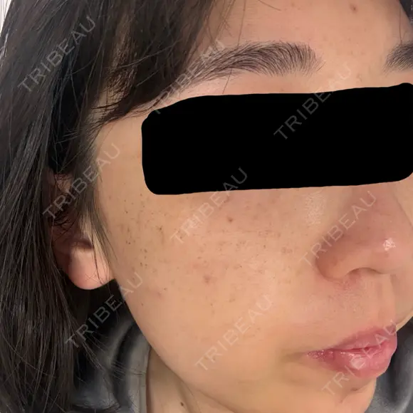 ピーリング（ニキビ・毛穴） / ルメッカ 大美会クリニック 梅田院 DAY 6 メイン用