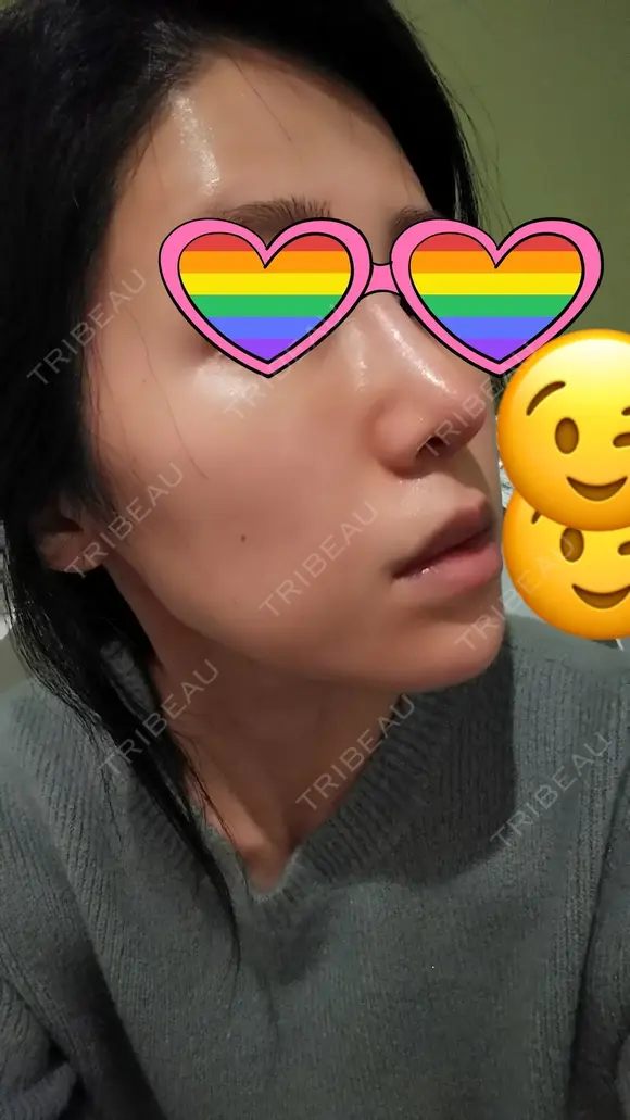 鼻尖形成（切開） / 軟骨移植 表参道スキンクリニック 表参道院 DAY 7 メイン用